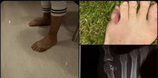 Conor McGregor toe injury
